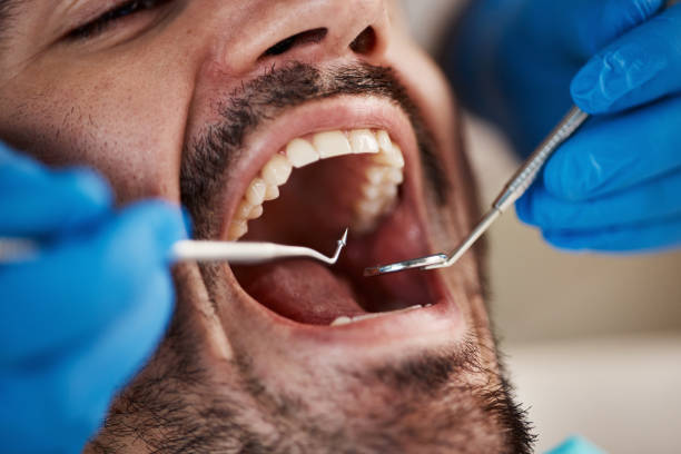 Best Broken or Chipped Tooth Repair in Romoland, CA